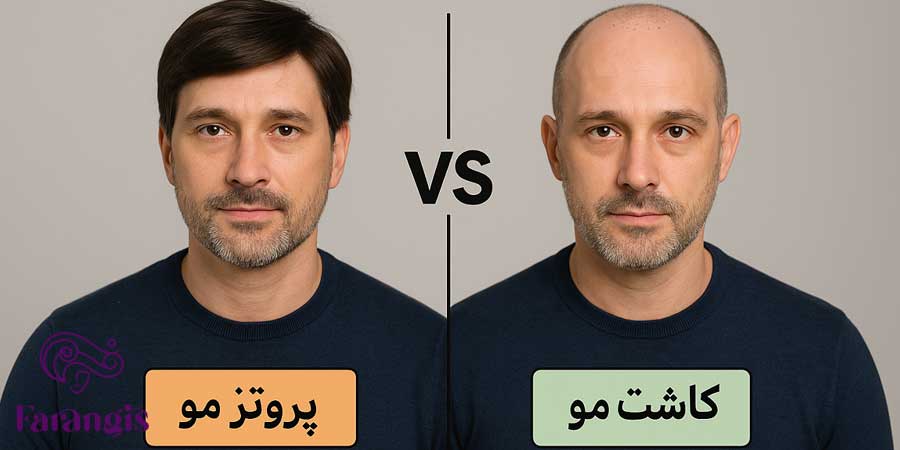 پروتز مو بهتر است یا کاشت مو